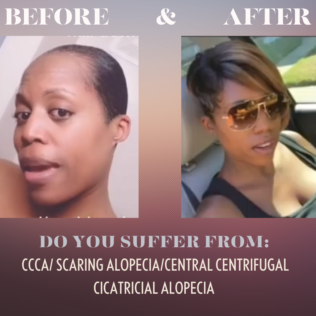 Customized Alopecia Hair Unit Topper for Women Suffering from Alopecia